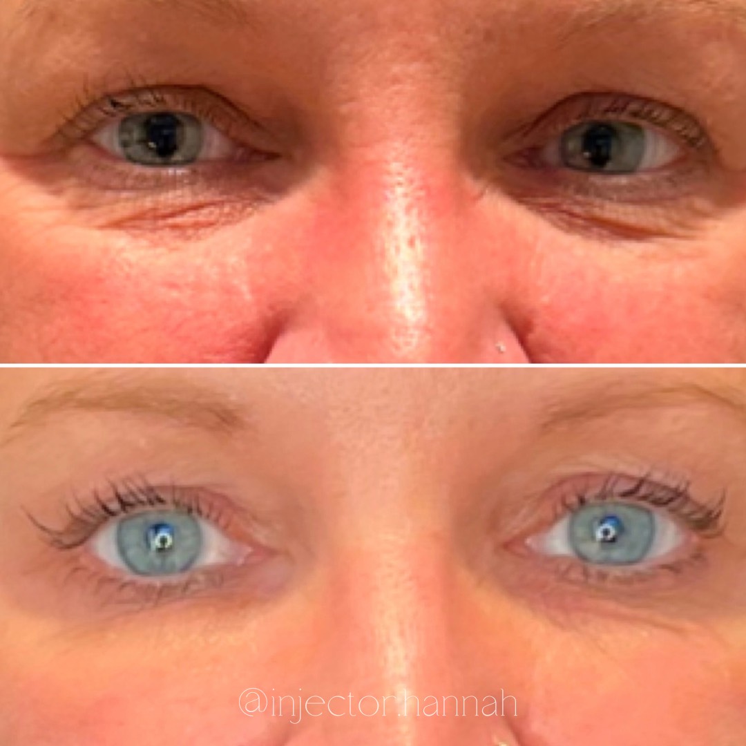 Forehead lines before/after – smoother after 2 weeks